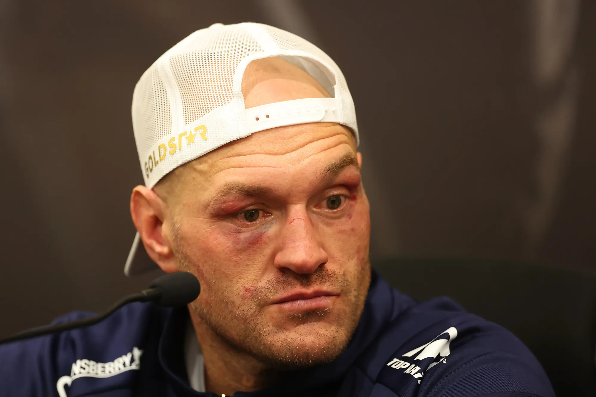 Tyson Fury in the postfight press conference; his face is marked, his expression is stoic, and his eyes are staring a thousand-yards.